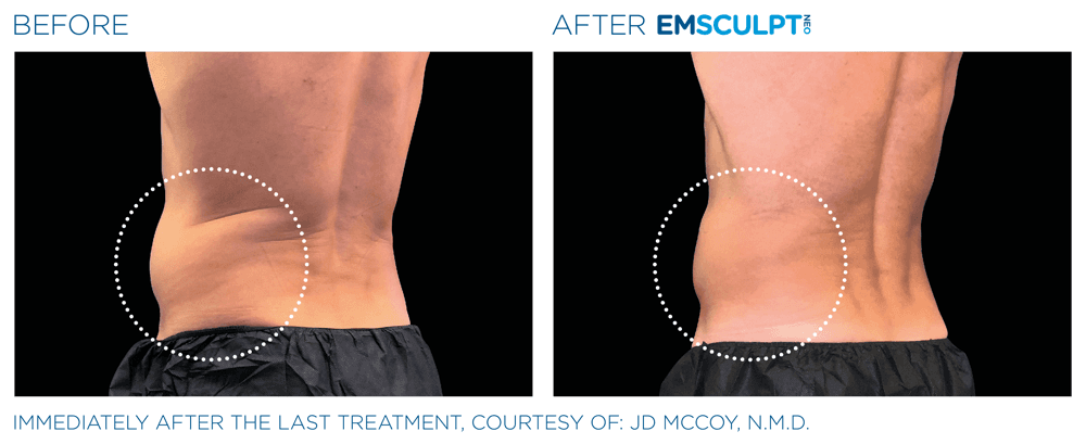 Emsculpt Neo Abdomen 11