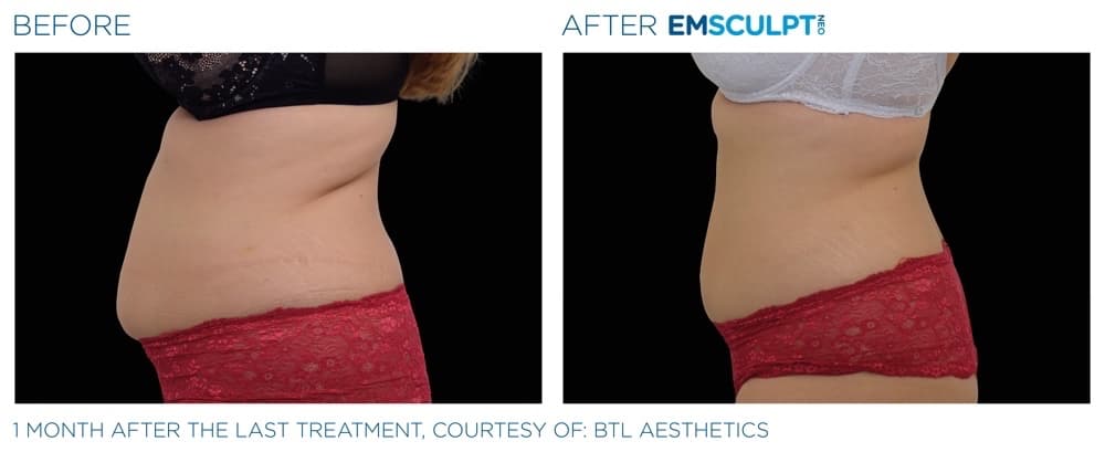 Emsculpt Neo Abdomen 6