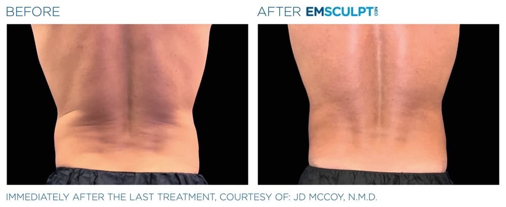 Emsculpt Neo Abdomen 9