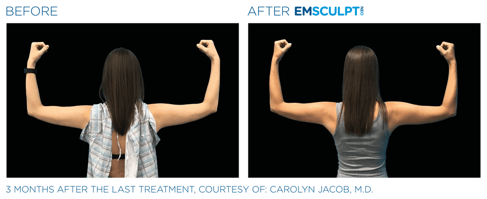 Emsculpt Neo Arms 5