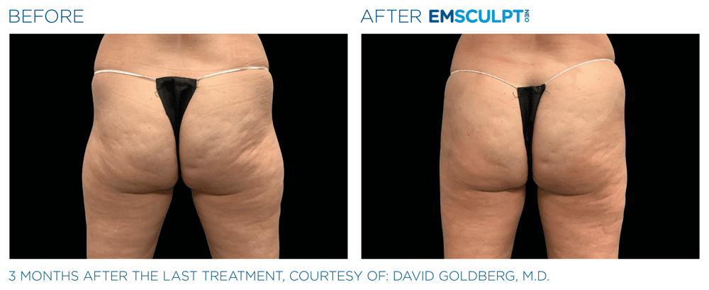 Emsculpt Neo Buttocks 1