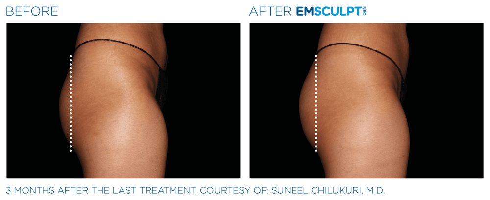 Emsculpt Neo Buttocks 2