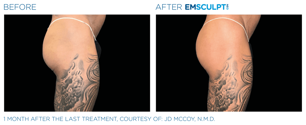 Emsculpt Neo Buttocks 4