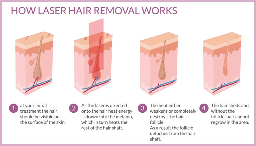 Laser Hair Removal