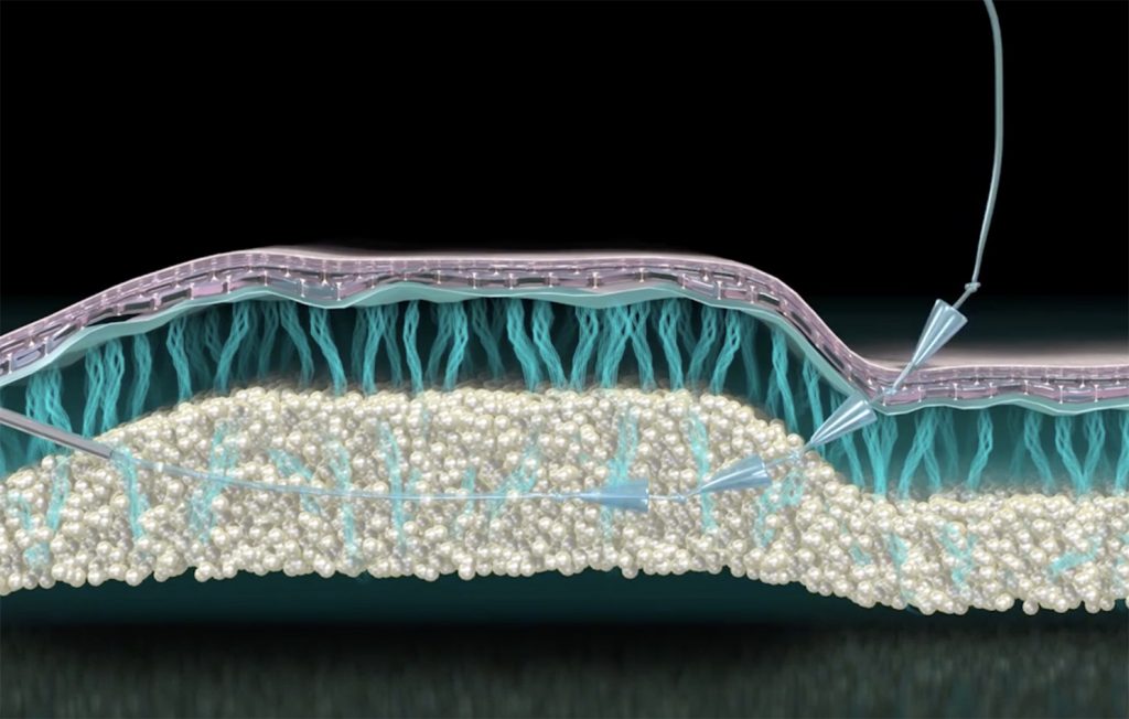 Silhouette Instalift